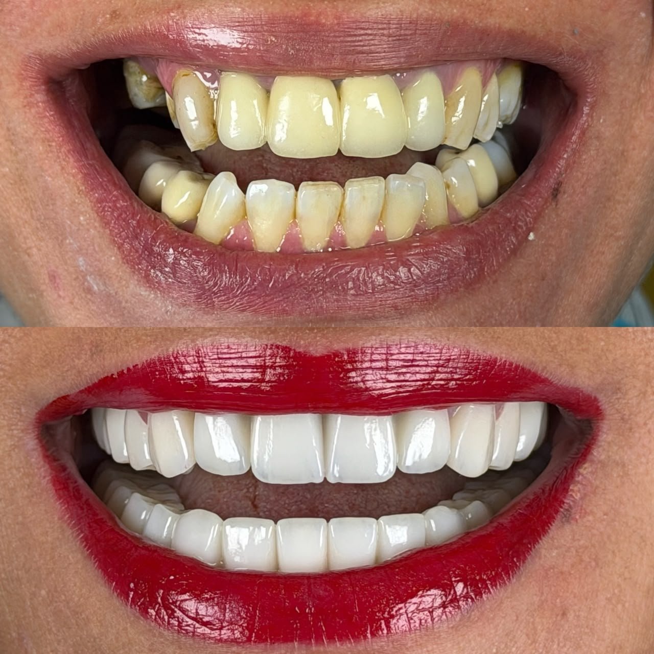 Zirconia crowns — Before / After 1