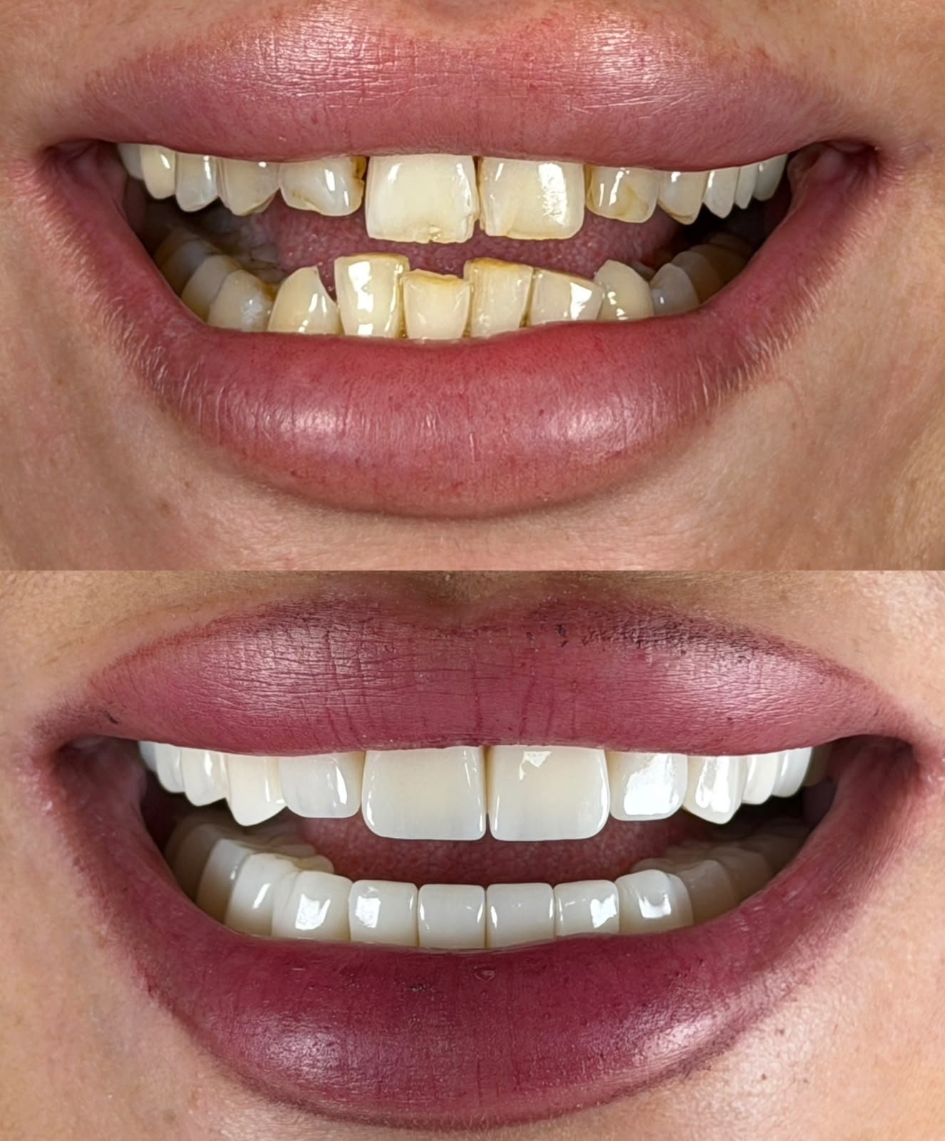 Zirconia crowns — Before / After 2