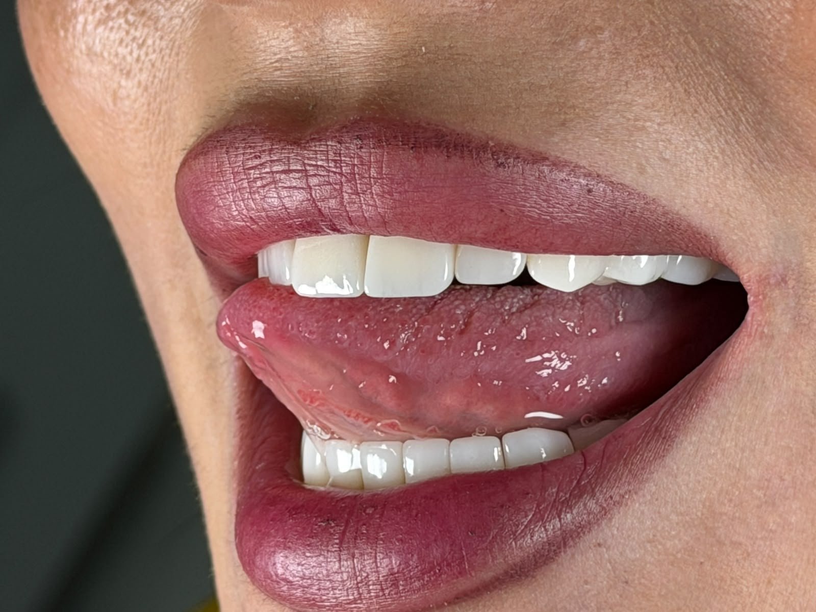 Zirconia crowns — Before / After 3