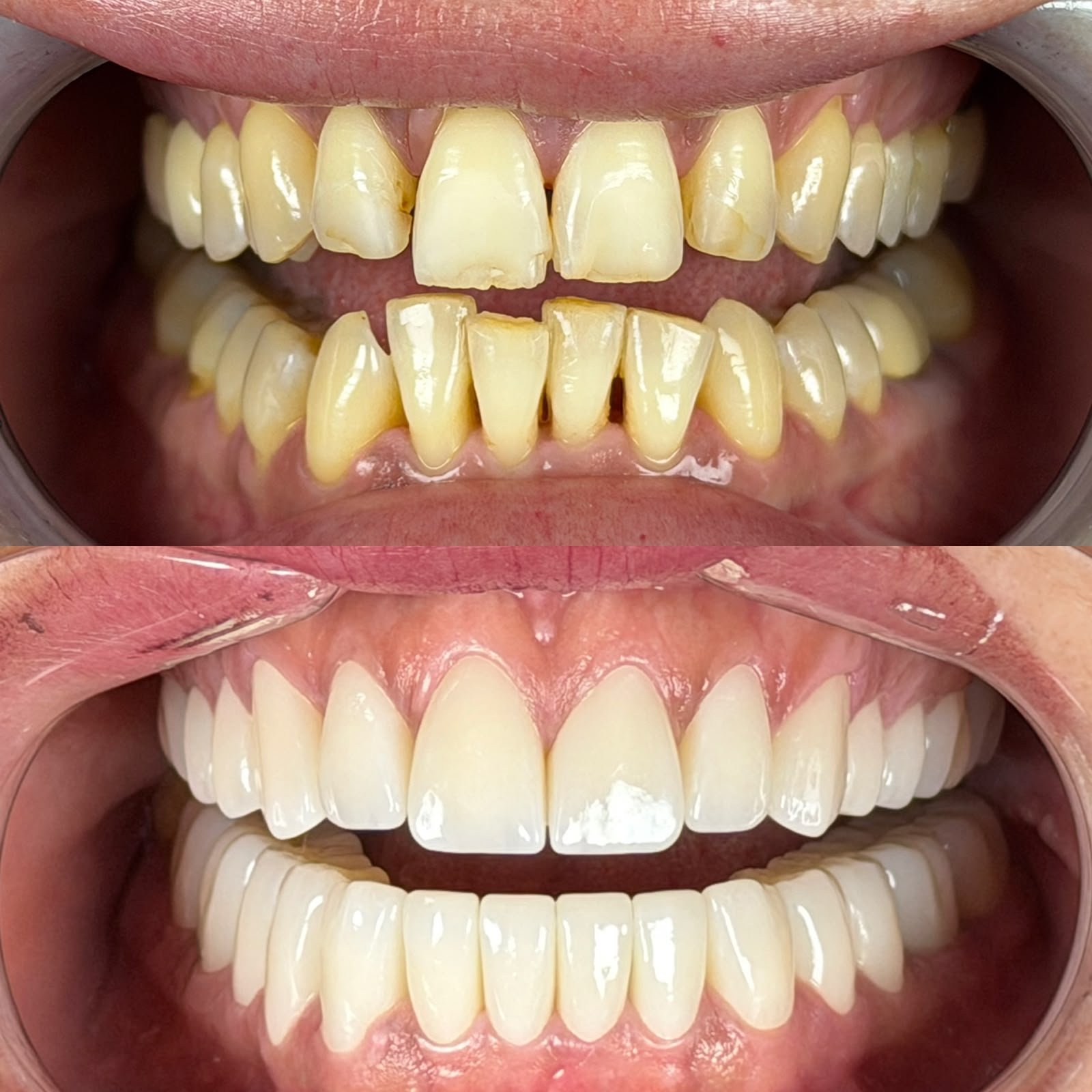 Zirconia crowns — Before / After 4