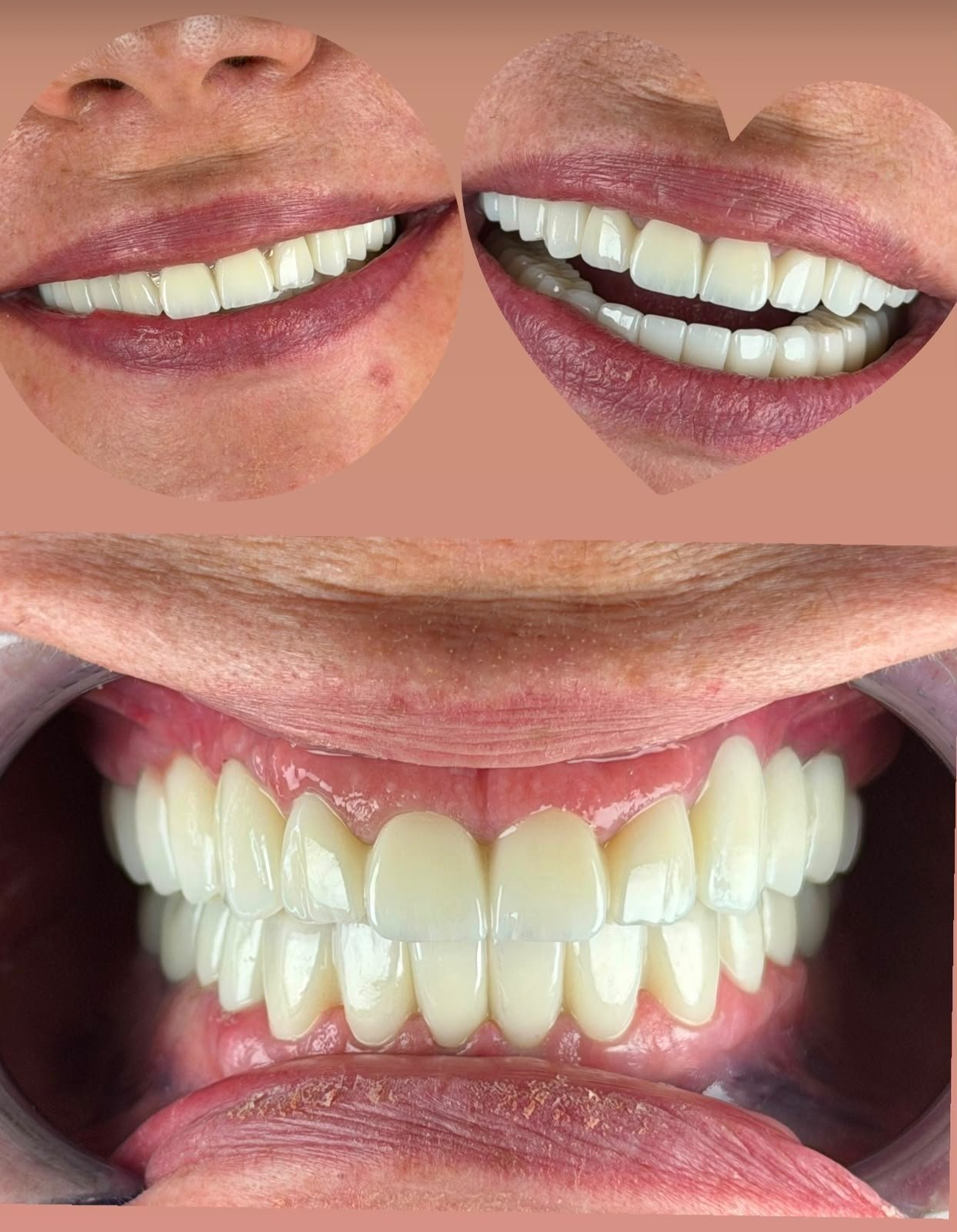Zirconia crowns — Before / After 5