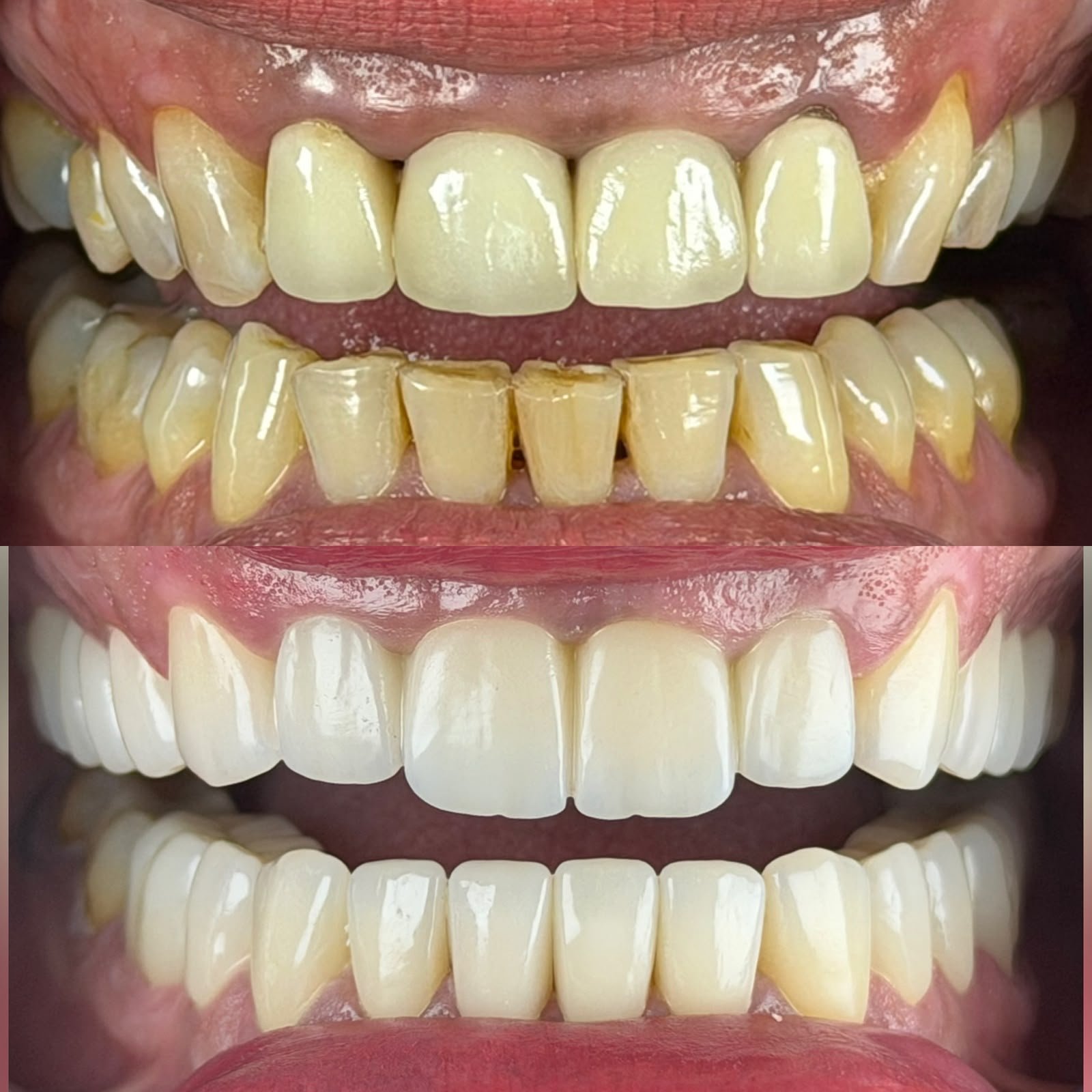 Zirconia crowns — Before / After 6